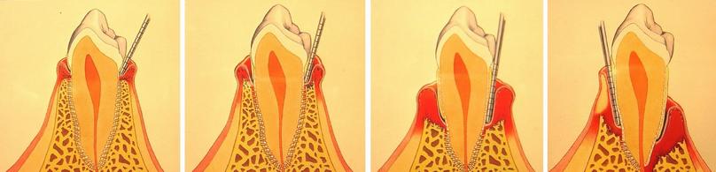 progress of periodontitis